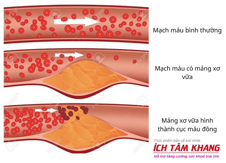 Cục máu đông được hình thành trong động mạch chủ yếu do mảng xơ vữa nứt vỡ trong lòng mạch